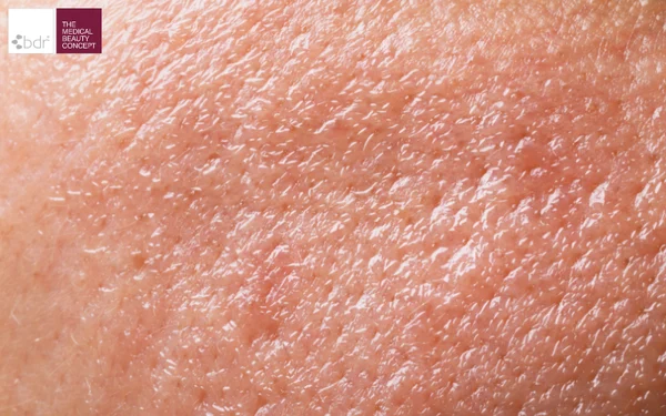 Giải pháp chăm sóc và phục hồi làn da đổ dầu thiếu ẩm tại nhà